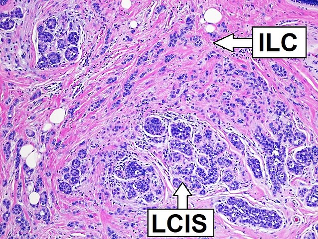 Invasive or infiltrating ductal carcinoma